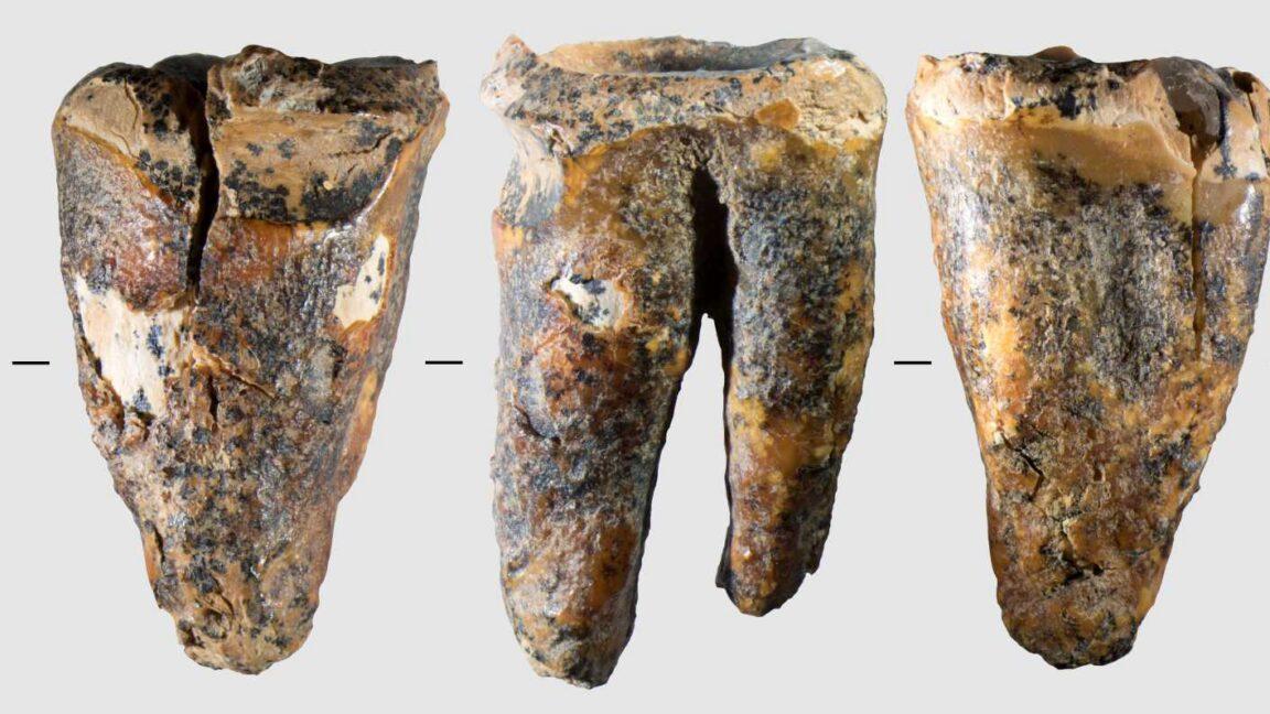 Neanderthals drilled cavities to treat a toothache 59,000 years ago