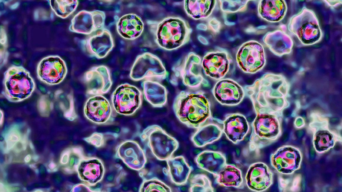South Carolina's measles outbreak jumped to Washington state 5 times in 2 weeks